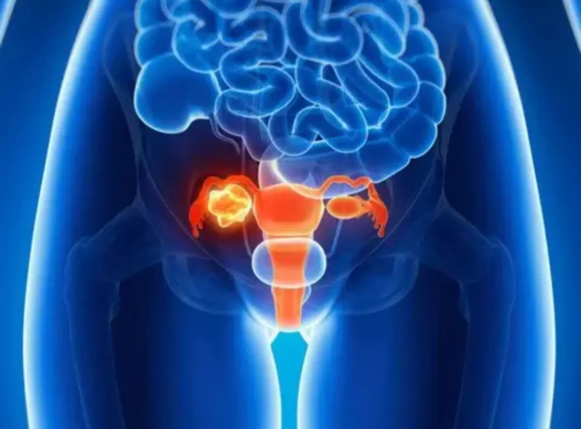Día Mundial del Cáncer de Ovario: origen, síntomas y los factores que lo producen